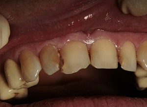 Кариес контактной поверхности зубов