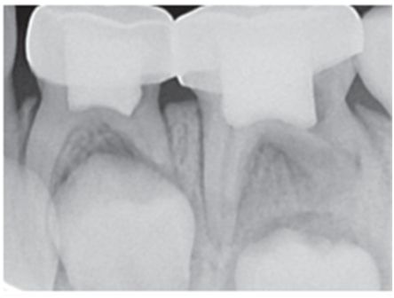 Примеры проведенного эндодонтического лечения молочных зубов.jpg