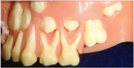 Молочные и постоянные зубы в модели верхней челюсти. Период молочного прикуса.jpg