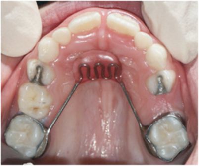 Примеры ортодонтической аппаратуры (1).jpg