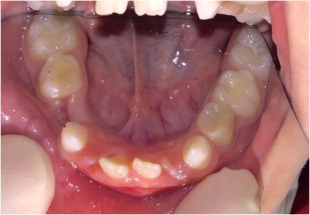 Пациент, 7 лет, на этапе подготовки к ортодонтическому лечению.jpg