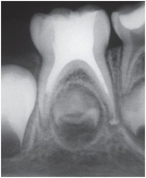 Примеры проведенного эндодонтического лечения молочных зубов2.jpg